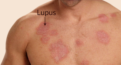 Kenali Lebih Dekat Penyakit Lupus