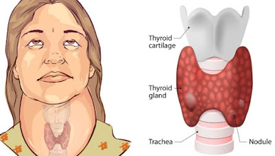 10 Signs You Have a Thyroid Problem and 10 Ways to Deal With It [Health remedies]