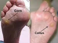 Corns And Callosities: The Most Effective Natural Herbal Cure 