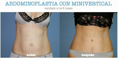 abdominoplastia_cirugia_plastica_abdomen_cirujano_plastico