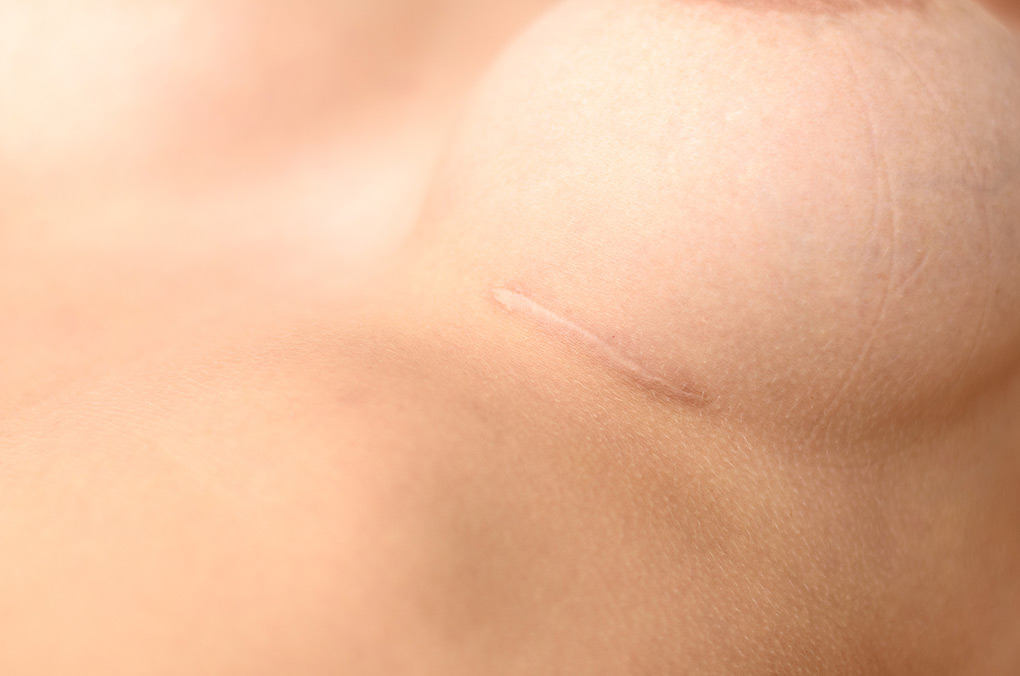 Breast Implant Scars. What you need to know.(breast augmentation recovery)