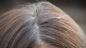 GRAYING OR WHITENING OF HAIR