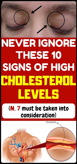 10 Terrible Symptoms of High Cholesterol That You Don't Have to Ignore
