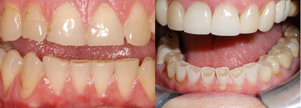 nguyên nhân nghiến răng 2