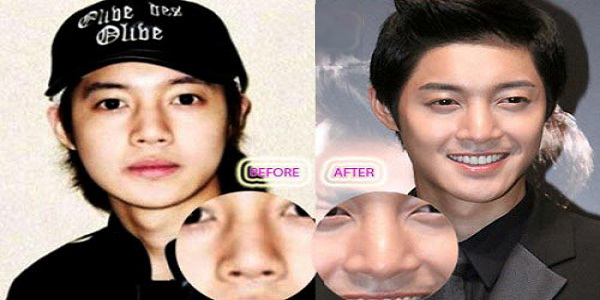 Kim Hyun Joong Operasi Hidung