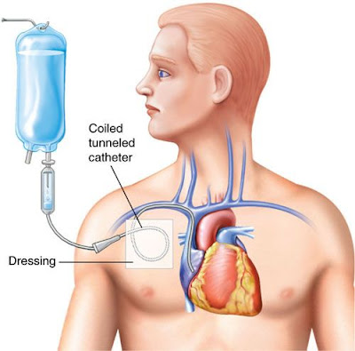  TUNNEL CATHETER