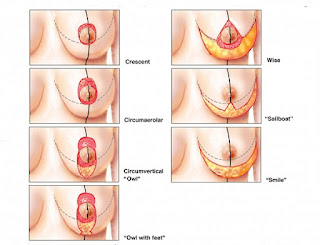 nâng ngực chảy xệ có đắt không