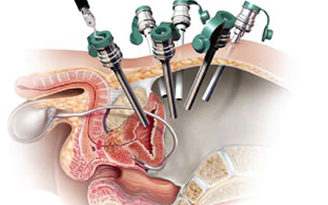 Diagnosis And Reporting Of Benign Prostatic Hyperplasia