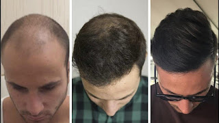 زراعة الشعر واضرارها وسعرها