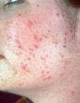 get rid of my acne pic3