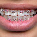 Răng mọc lệch lạc có điều trị bằng niềng răng được không?