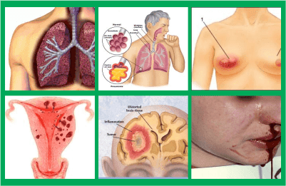 tips jitu cara cepat buat mengempiskan kanker rongga tenggorokan, harga resmi cara menyembuhkan buat kanker payudara pada ibu nifas, tanya yg cara menyembuhkan buat kanker paru-paru herbal