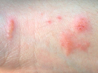 https://commons.wikimedia.org/wiki/File:Poison_ivy_contact_dermatitis.jpg