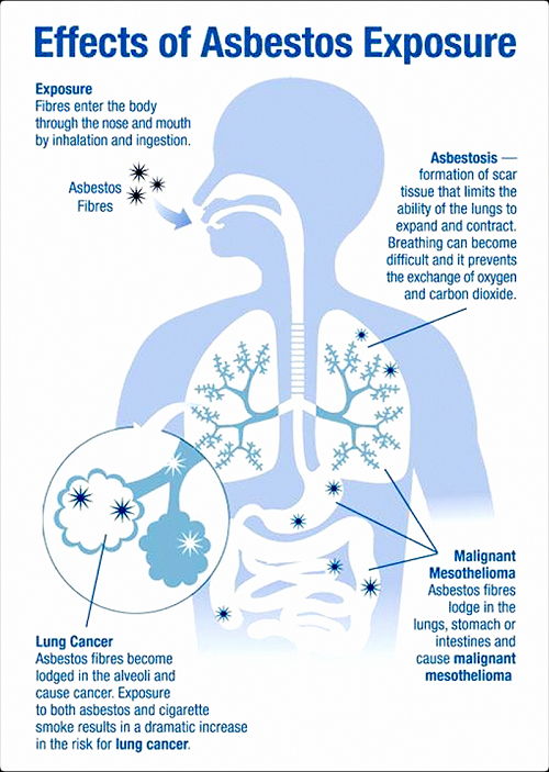 Image Asbestos Exposure Symptoms