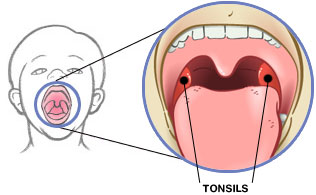 KESEHATAN ANAK: Penyakit Teling Hidung dan Tenggorokan