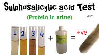 Sulphosalicyclic acid test for albumin in urine,Sulphosalicyclic acid test, albumin in urine