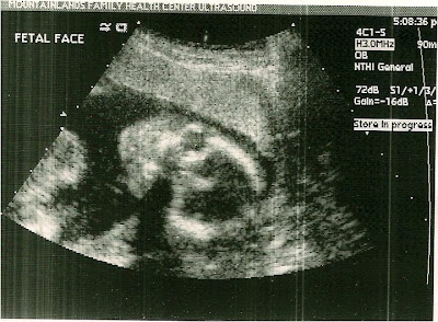 20 Week Ultrasound