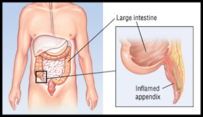 এ্যাপেন্ডিসাইটিস [ Appendicitis ] এর হোমিওপ্যাথিক চিকিৎসা