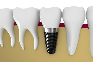 Dental Implants