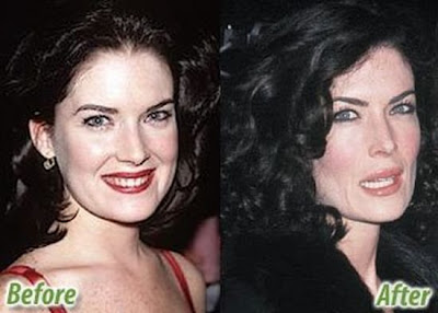 celebrity plastic surgery