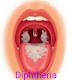 खुन्नाक( Diphtheria) लक्षण, आयुर्वेदिक व एलोपैथी इलाज।