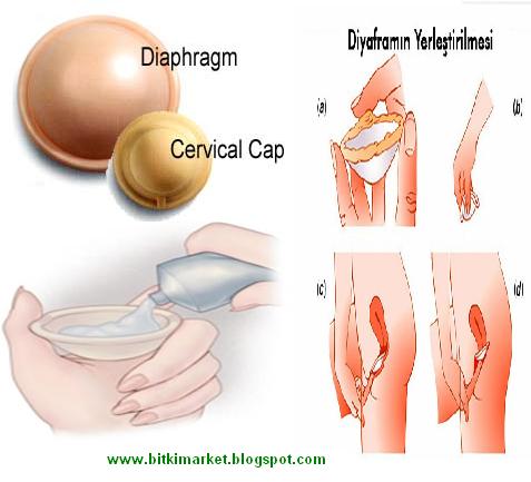 DOĞUM KONTROLÜNDE DİYAFRAM UYGULAMASI NEDİR?