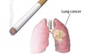 Penyebab Terbesar Kanker Paru adalah Rokok - baik itu first hand smoke, second hand smoke, maupun third hand smoke yang berasal dari Baju-Baju yang Terpapar Zat-zat Berbahaya dari Rokok
