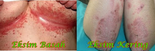 Eksim Kering Pada Wajah, Cara Mengobati gatal eksim Yang Menahun, Cara Obat Alami gatal eksim Basah, Obat Eksim Atau Dermatitis, Apakah gatal eksim Kering Bisa Sembuh Total, Obat Eksim Manjur, Cara Mengobati Eksim Basah Pada Anak, Mengatasi Penyakit gatal eksim, Mengobati Eksim Pada Telapak Tangan, Gatal Di Batang Kemaluan, Obat Alami gatal eksim Pada Kulit, Mengobati gatal eksim Kering, Mengurangi Rasa Gatal Di Selangkangan, Cara Ngilangin Gatal Di Kemaluan, Tumbuhan Obat Eksim Kering, Obat Oral Untuk Eksim Kering, Gejala Penyakit Eksim Basah, Obat gatal eksim Yang Aman Untuk Ibu Menyusui, Obat Eksim Basah Tradisional, Eksim Ringan, Eksim Adalah Penyakit, Gejala Gatal Di Selangkangan, Cara Mengobati Penyakit Eksim Menahun, gatal eksim di ketiak, Lama Penyakit Eksim, Cara Mengobati Penyakit gatal eksim Di Kaki, Obat gatal eksim Kulit Bayi, Mengobati Eksim Dengan Vco, Cara Menghilangkan Eksim Susu Pada Wajah Bayi, obat gatal eksim basah, Mengobati Eksim Dengan Bahan Alami, Pengobatan Penyakit gatal eksim Basah, gatal eksim Yang Parah, Cara Menyembuhkan Penyakit gatal eksim Di Kaki, obat gatal jamur eksim 