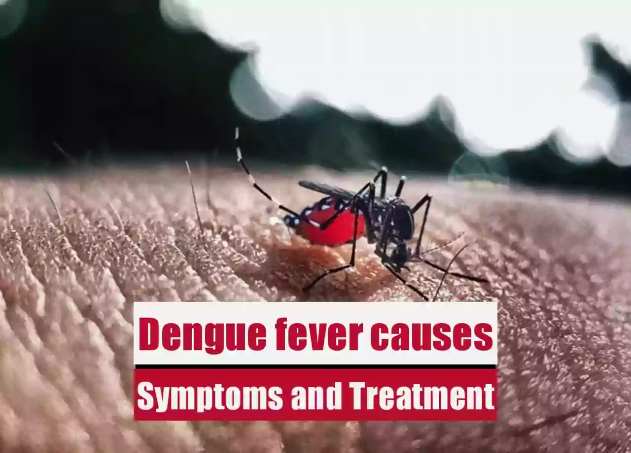 Dengue fever causes, Symptoms and Treatment