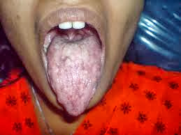 How you can Successfully Clean up a White Tongue, the reason for Bad Breath