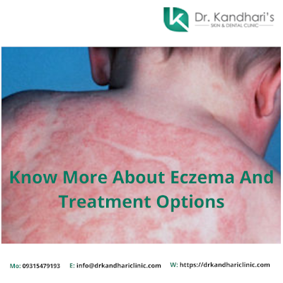 Know More About Eczema And Treatment Options