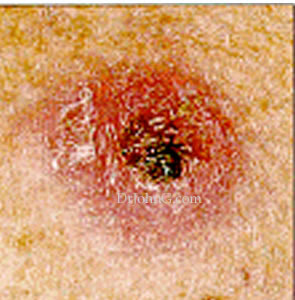 Skin Cancer