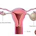 Những loại u nang buồng trứng thường gặp