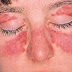 Causes of Sunburn or Sun Poisoning
