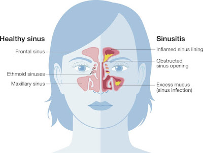 Ciri-ciri dan Gejala Penyakit Sinusitis