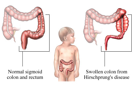 MEDICAL BLOG Penyakit Hirschsprung Congenital 
