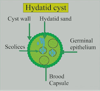 Hydatid Cyst