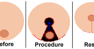 Pendulous breasts Definition, Breast Feeding, Lift, Large