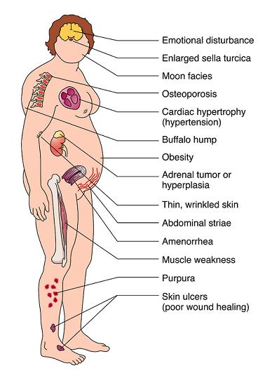 Cushing disease Signs and symptoms (http://www.medicalstudystuff.tk)