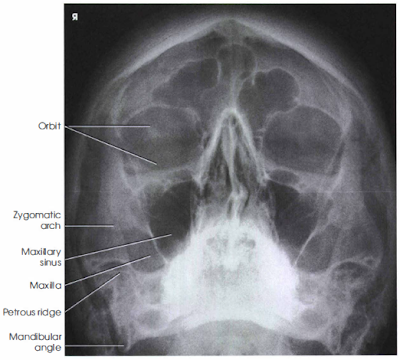 FACIAL BONES X RAY | PARIETOACANTIAL PROJECTION ...