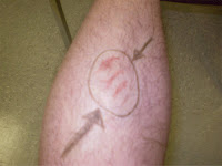 burns caused due to laser hair removal treatment