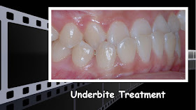 Underbite treatment, no jaw surgery, non extraction, class III, Orthodontics, orthodontists, Clear, Invisible, Braces, Invisalign, underbite,class III, face mask, non-surgery, non-extraction, crossbite, overbite, class II, crooked, spaced, crowding, teeth, severe, jaw alignment, cosmetics, implants, children, dentists, dentistry, friendly, adults, children, family, Lawrenceville, Norcross, Buford, Hamilton Mill, Dacula, Auburn, Sugar Hill, Sugar Loaf, Doraville, Chamblee, Stone Mountain, Decatur, Collins Hill, Snellville, Suwanee, Grayson, Lilburn, Duluth, Cumming, Alpharetta, Marietta, Dekalb, Gwinnett, County, Atlanta, North Georgia, GA, Georgia, 30043, 30093, affordable, Vietnamese, Spanish, weekend, Saturday, appointments, Dr. Quang Nguyen, Georgia Orthodontic Care, Nguyen Orthodontics. 