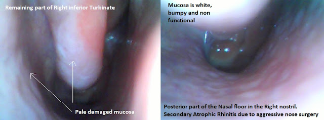 Emty nose syndrome after Partial turbinate reduction