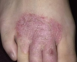 Cara Mengatasi Penyakit Dermatitis Atau Eksim, Gatal Eksim Pada Kaki Bayi, Penyakit Eksim Cara Gampang, Cara Mengobati Penyakit Eksim Tradisional, Obat Gatal Kemaluan Pria, Obat Manjur Penyakit Gatal Eksim, Gatal Eksim Sembuh Dengan Bekam, Gatal Eksim Pada Lengan, Obat Gatal Eksim Kering Untuk Bayi, Obat Eksim Sinshe, Gatal Eksim Pada Wajah, Obat Alami Gatal Miss V, Gatal Di Selangkangan Karena Apa, Obat Alami Gatal Gatal Di Sekitar Kemaluan, Obat Eksim Kering Dan Basah, Cara Menyembuhkan Penyakit Kulit Eksim Basah, Obat Tradisional Fagina Gatal, Obat Alami Gatal Gatal Pada Ibu Hamil, Mengobati Eksim Secara Tuntas, Obat Herbal Untuk Gatal Jamur, Mengobati Eksim Basah Dengan Bahan Alami, Cara Mengobati Gatal Eksim Kering Pada Anak, Obat Salep Penghilang Gatal Pada Selangkangan, Obat Alami Menghilangkan Gatal Pada Selangkangan, Cara Mengobati Kulit Gatal Eksim Kering