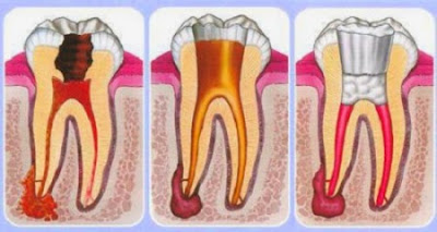 Điều trị tủy răng bằng vi phẫu hiện đại là gì?