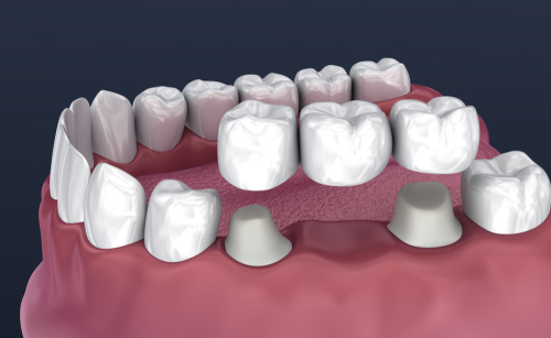 Multiple tooth replacement tamil nadu