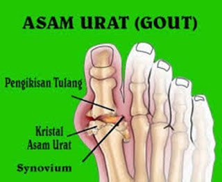 Makanan Yang Mengurangi Asam Urat Dan Kolesterol, Nama Obat Untuk Penyakit Asam Urat, Kadar Normal Asam Urat Gula Darah, Suplemen Untuk Asam Urat Dan Kolesterol, Cara Menyembuhkan Asam Urat Atau Rematik, Cara Sehat Menurunkan Asam Urat, Penyakit Asam Urat Dan Makanan Pantangannya, Asam Urat Level, Asam Urat Hasil Lab, Obat Alami Asam Urat Paten, Obat Sakit Kaki Karena Asam Urat, Makanan Penyebab Asam Urat Dan Rematik, Makanan Asam Urat Dan Rematik, Tanaman Obat Asam Urat Kolesterol, Pencegahan Asam Urat Secara Alami, Menurunkan Asam Urat Cara Alami, Asam Urat Gula Darah Kolesterol Normal, Jamu Herbal Untuk Asam Urat Dan Kolesterol, Asam Urat Terbentuk Dari, Obat Asam Urat Kbm, Gejala Asam Urat Pada Lengan, Pantangan Asam Urat Susu, Buah Obat Asam Urat Kolesterol, Apakah Asam Urat Bisa Disembuhkan Secara Total, Mengobati Asam Urat Alami, Nama Obat Asam Urat Dan Kolesterol, Agar Cepat Sembuh Dari Asam Urat, Apakah Asam Urat Bisa Diurut, Asam Urat Makan Apa, Jus Herbal Asam Urat, Cara Menyembuhkan Sakit Asam Urat, Cara Mengatasi Asam Urat Kambuh, Ikan Yang Boleh Dikonsumsi Penderita Asam Urat Dan Kolesterol, Nilai Normal Asam Urat Kolesterol Dan Gula, Pantangan Bg Asam Urat, Gambar Sakit Asam Urat, Obat Untuk Mengobati Penyakit Asam Urat, Asam Urat Terlalu Rendah, Gejala Asam Urat Dan Pantangannya, Alat Ukur Gula Darah Kolesterol Asam Urat, Cara Pembuatan Obat Tradisional Asam Urat, Asam Urat Vs Terong, Pengobatan Alami Penyakit Asam Urat, Efek Asam Urat Naik, Cara Mengobati Asam Urat Dengan Lemon 