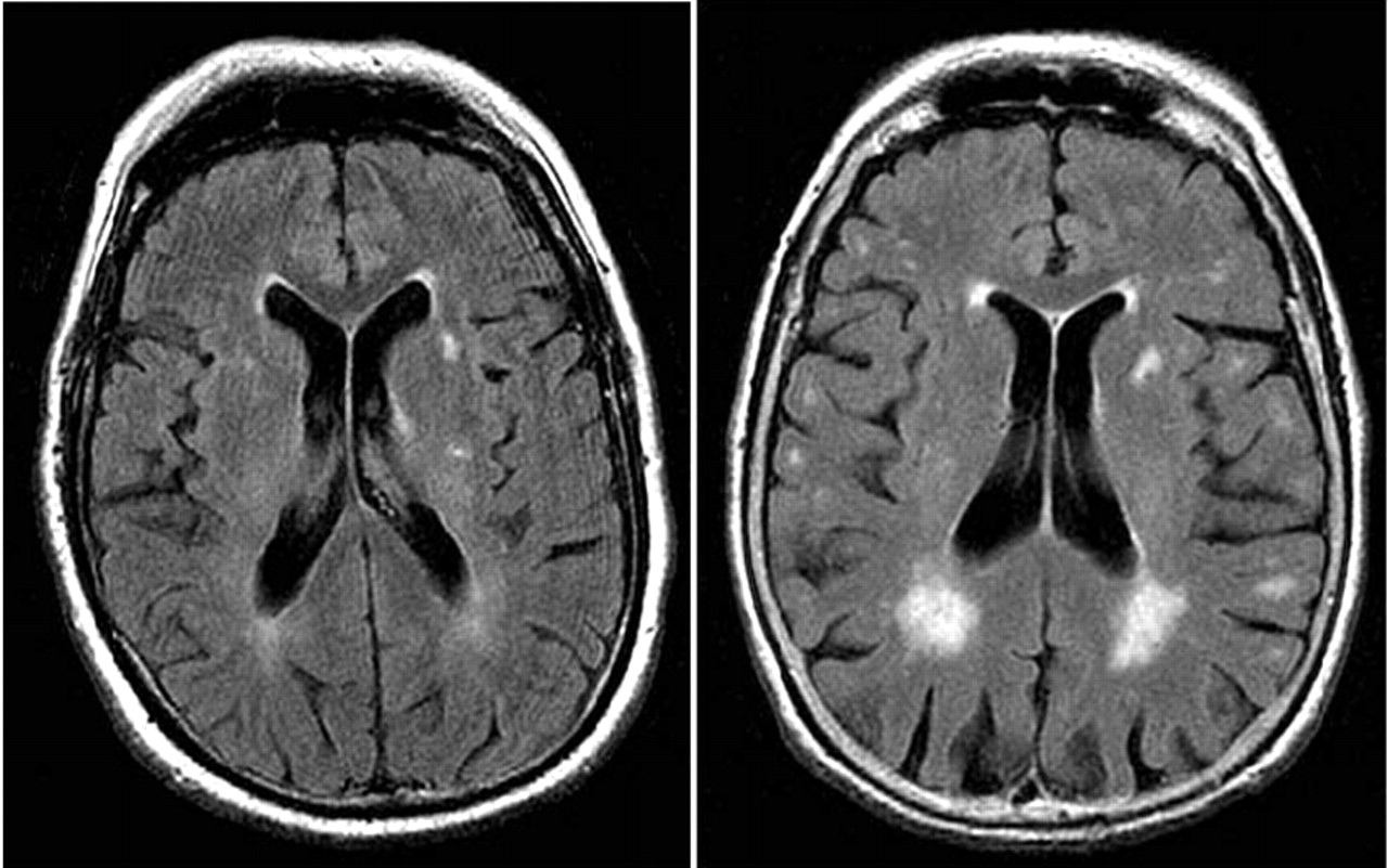 Brain Posts: Brain MRI White Matter Intensities: Clinical Significance