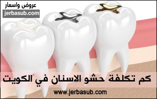 اسعار حشو الأسنان في الكويت