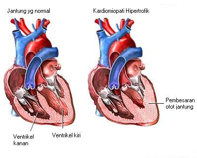 Kardiomiopati Hipertrofik